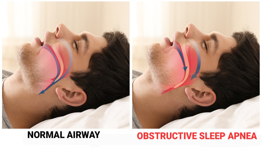 7 Signs You're Suffering From Sleep Apnea Without Realizing It